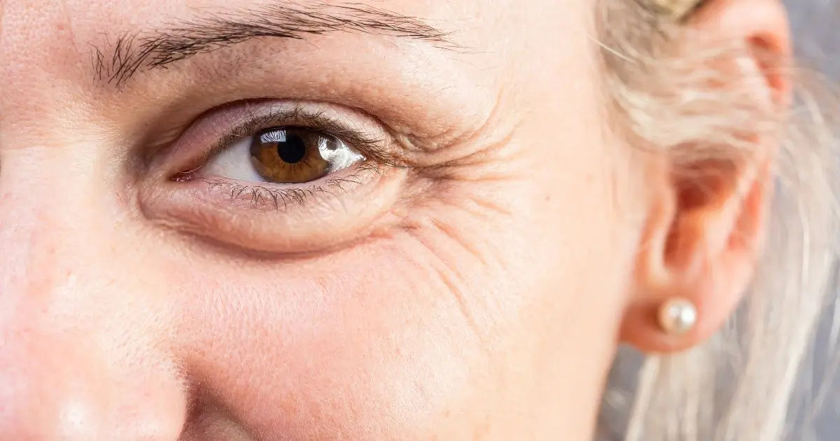 Best Treatment for Under-Eye Wrinkles: Top 5 Options
